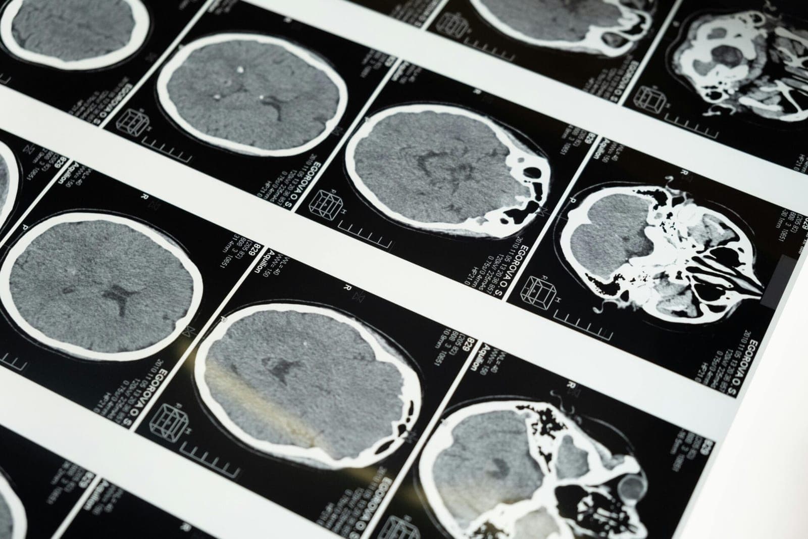 Trečiasis „Neuralink“ implantas sėkmingai veikia paciento smegenyse
