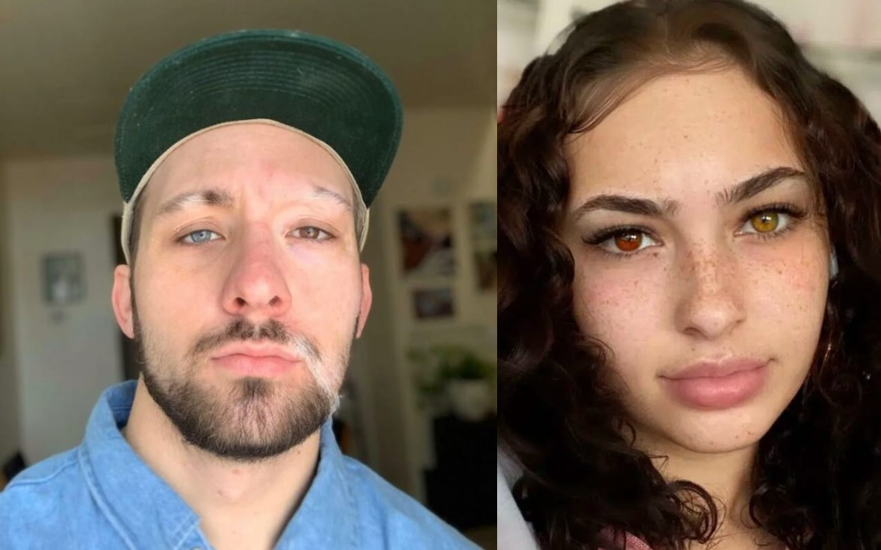 Heterochromia