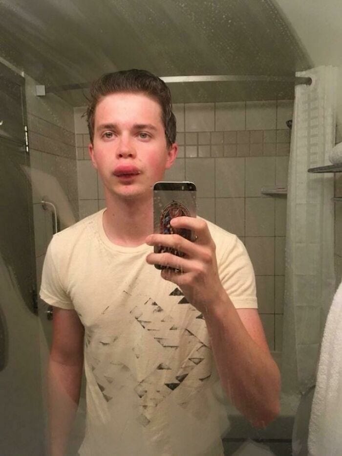 Ištinusios lūpos