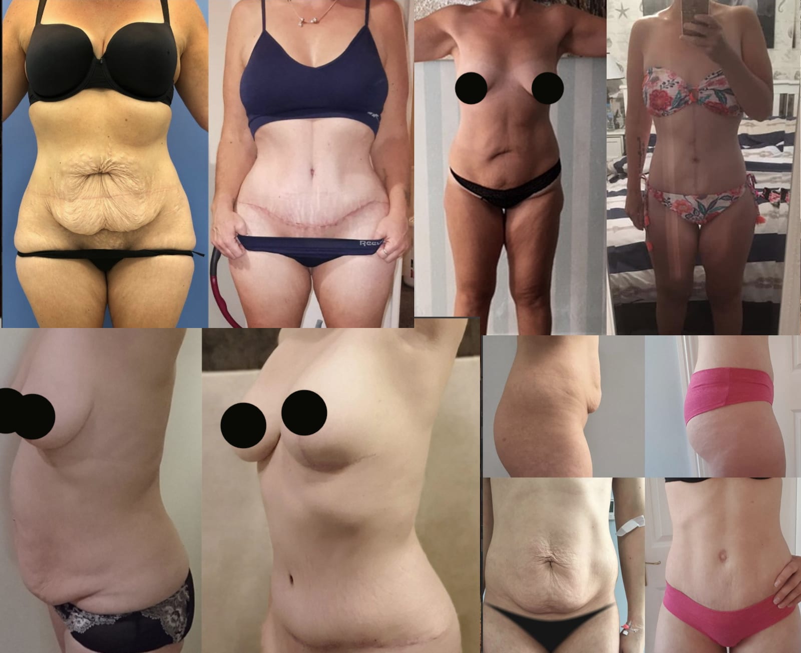 Abdominoplastika