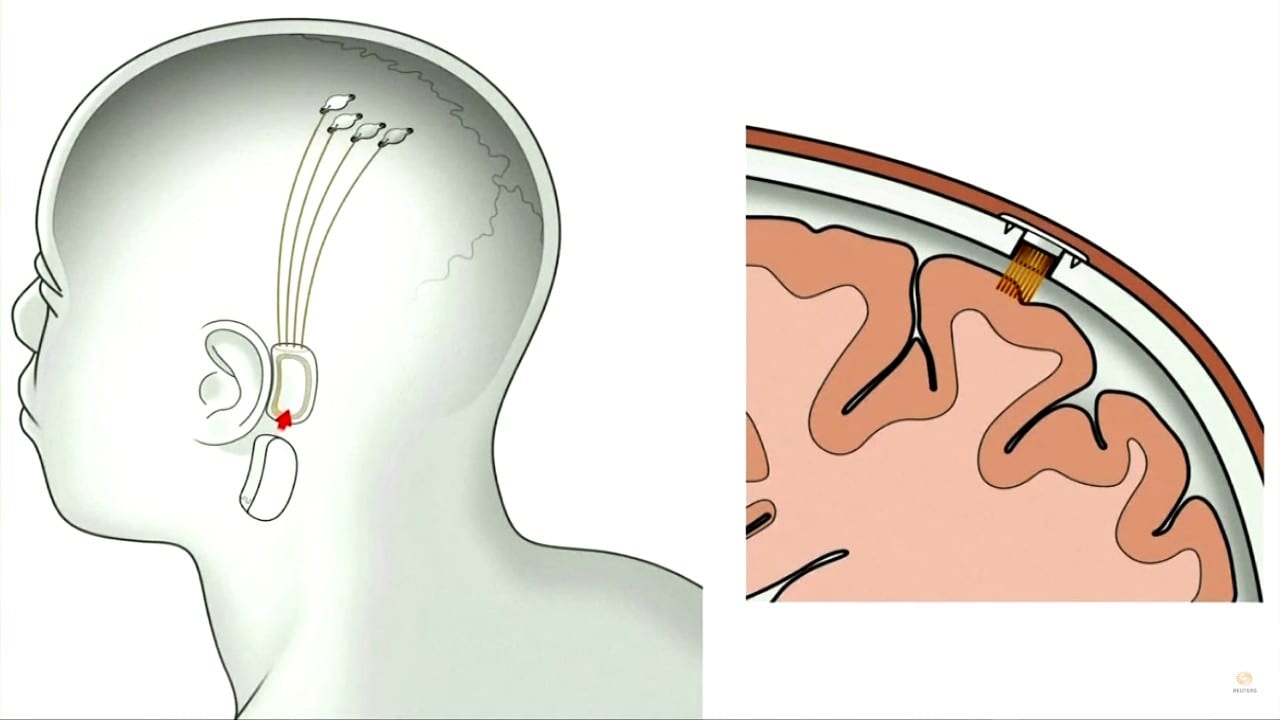 „Neuralink“ smegenyse